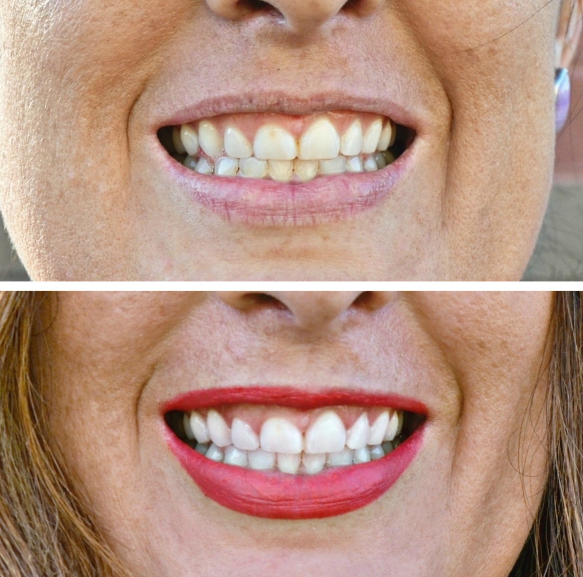 The Smile Brilliant teeth whitening at home kit makes a quick visible difference.
